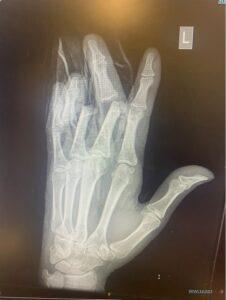 An x-ray image of Mahamad Hassan’s left hand showing the injuries suffered from the 2022 incident at Pork Farm's Riverside Bakery in Nottingham